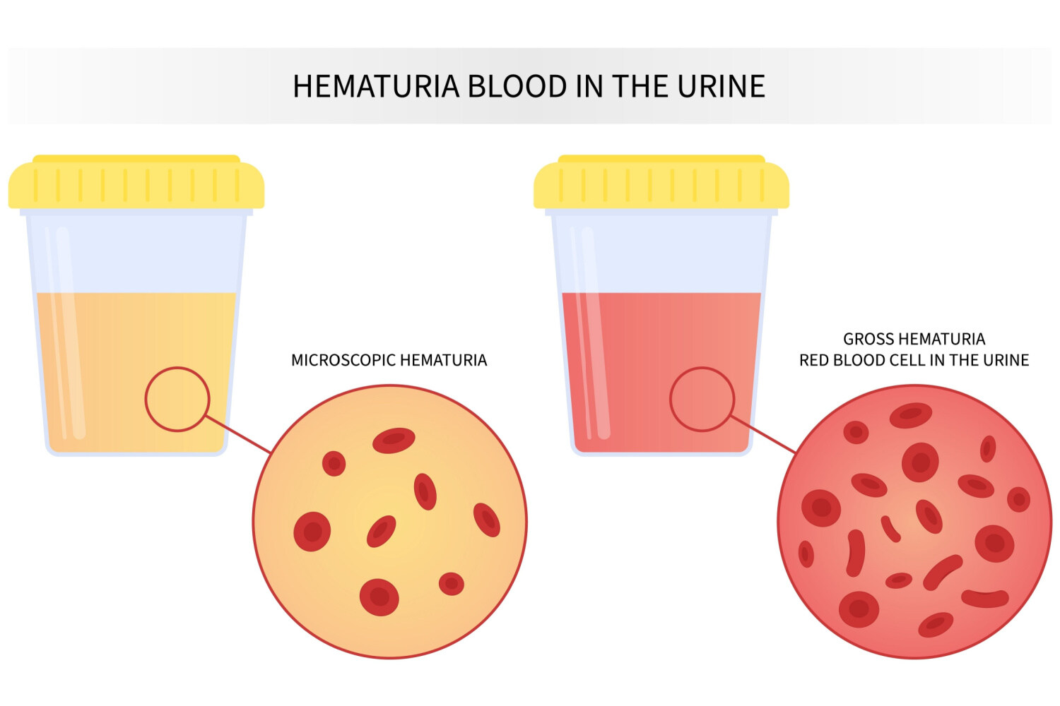Different types of hematuria