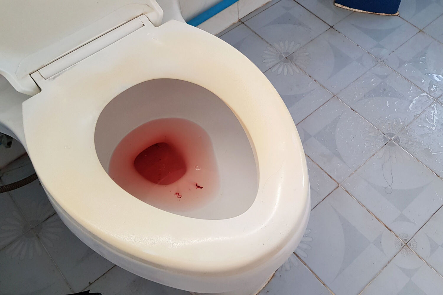 Blood in urine