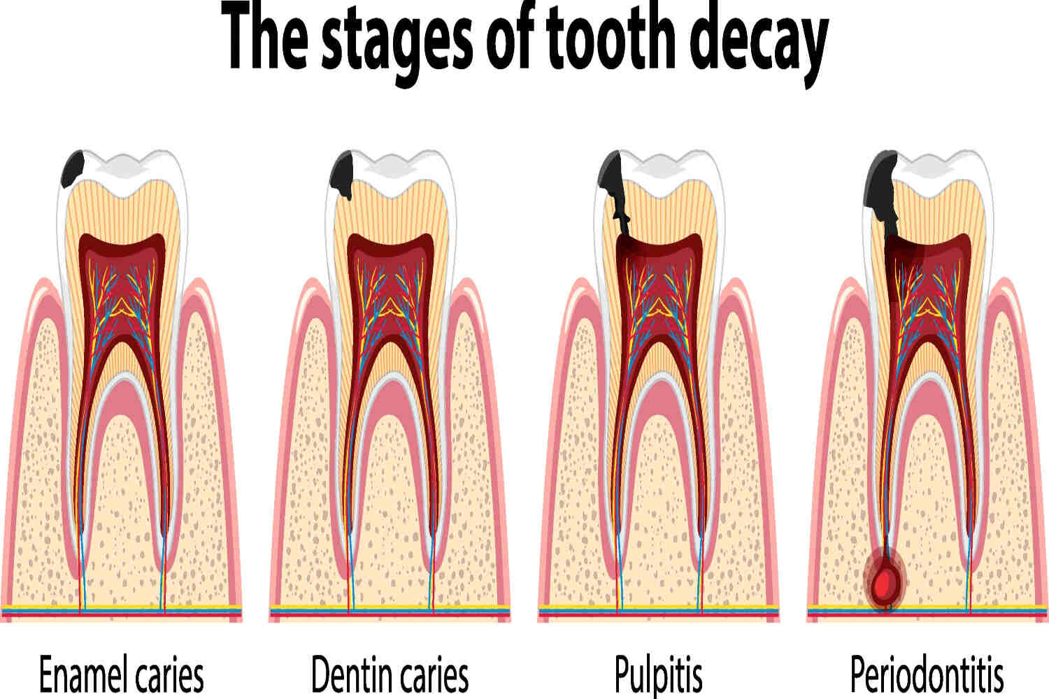 Different stages of tooth decay