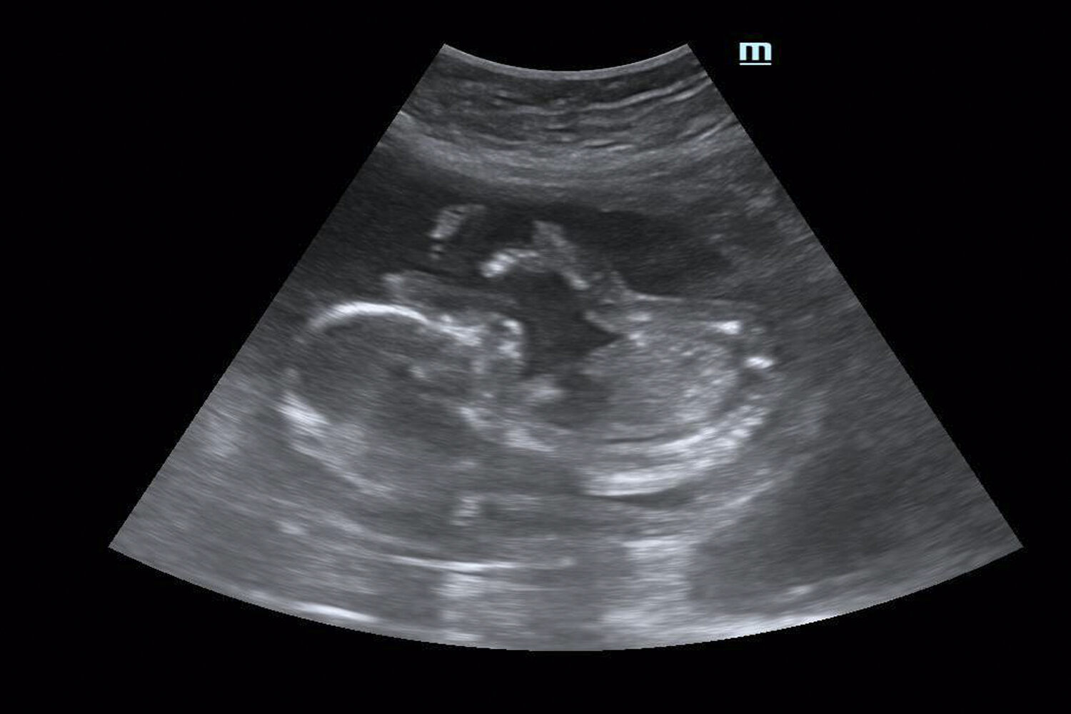 fetus ultrasound