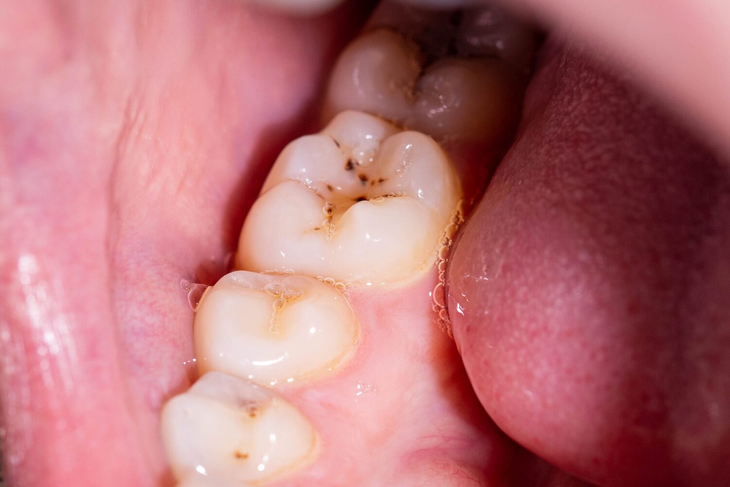 Teeth with decay