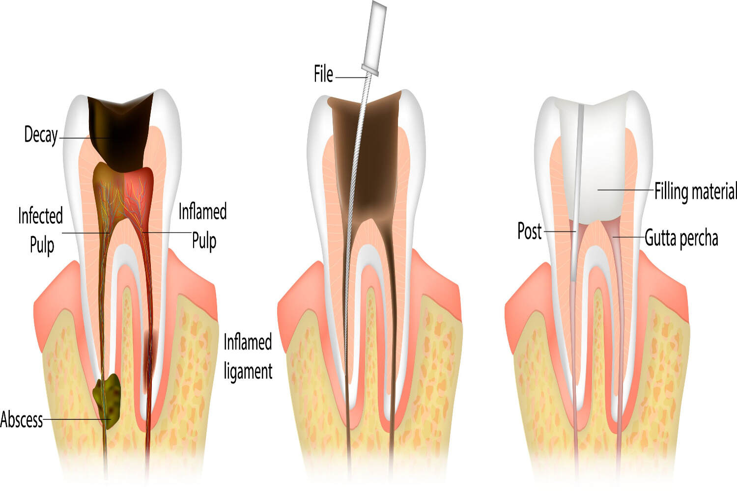 Root canal procedure