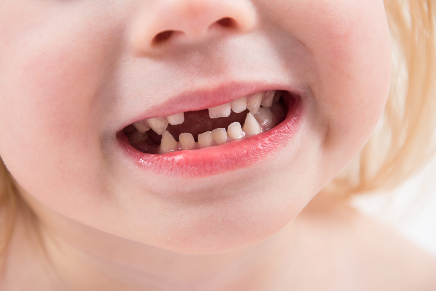 Early loss of baby teeth in kids