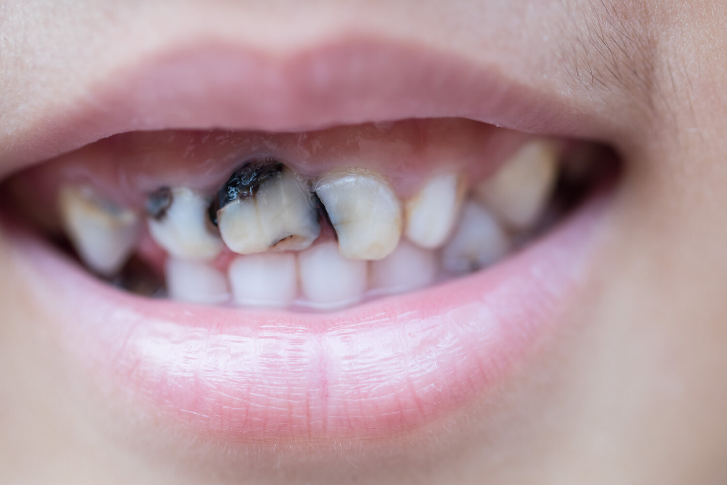 Teeth with cavities