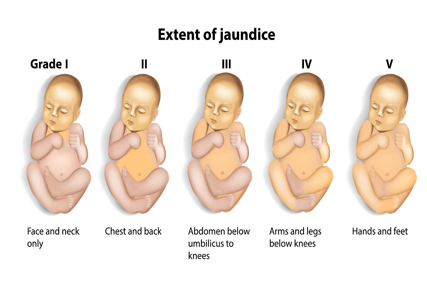 Bilirubin in babies