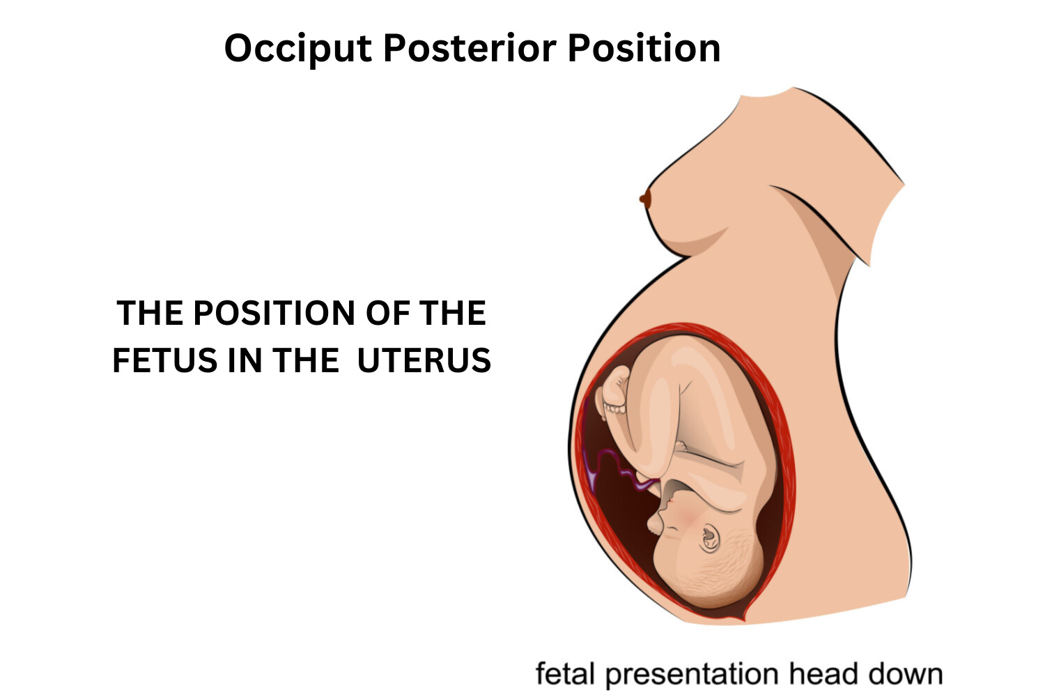 Occiput Posterior Position – Causes, Complications and Prevention