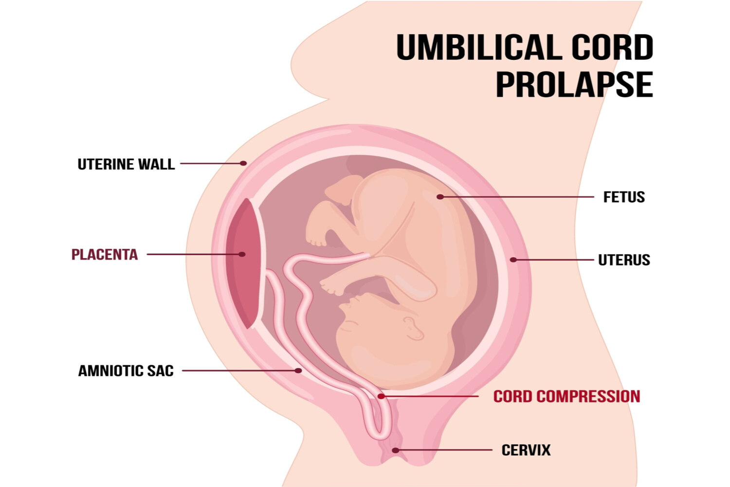 Umbilical Cord Prolapse