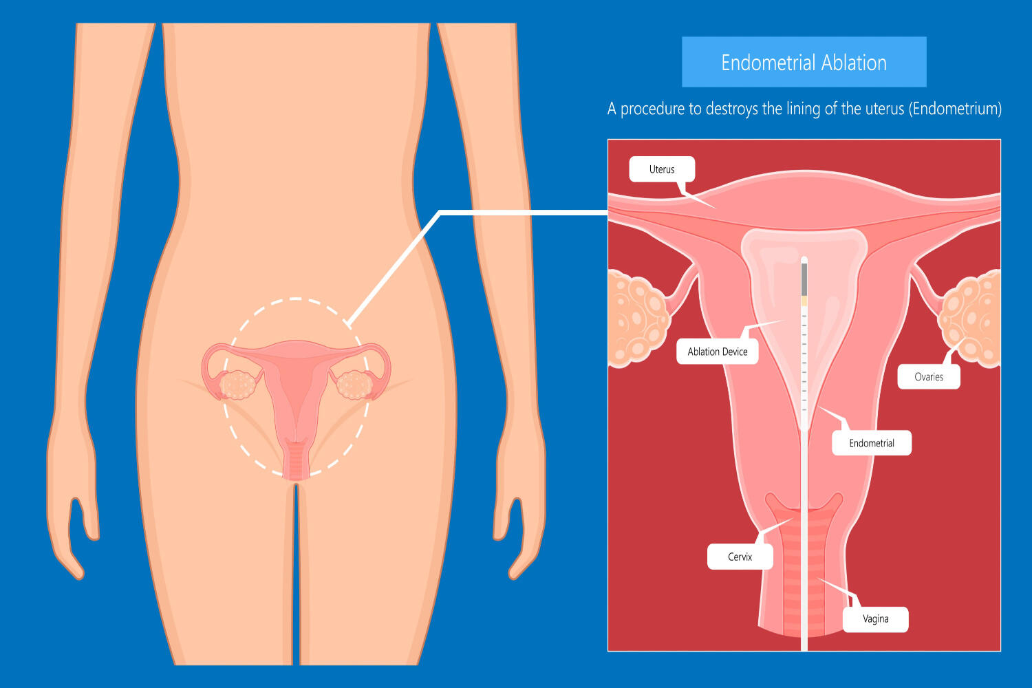 Endometrial ablation procedure