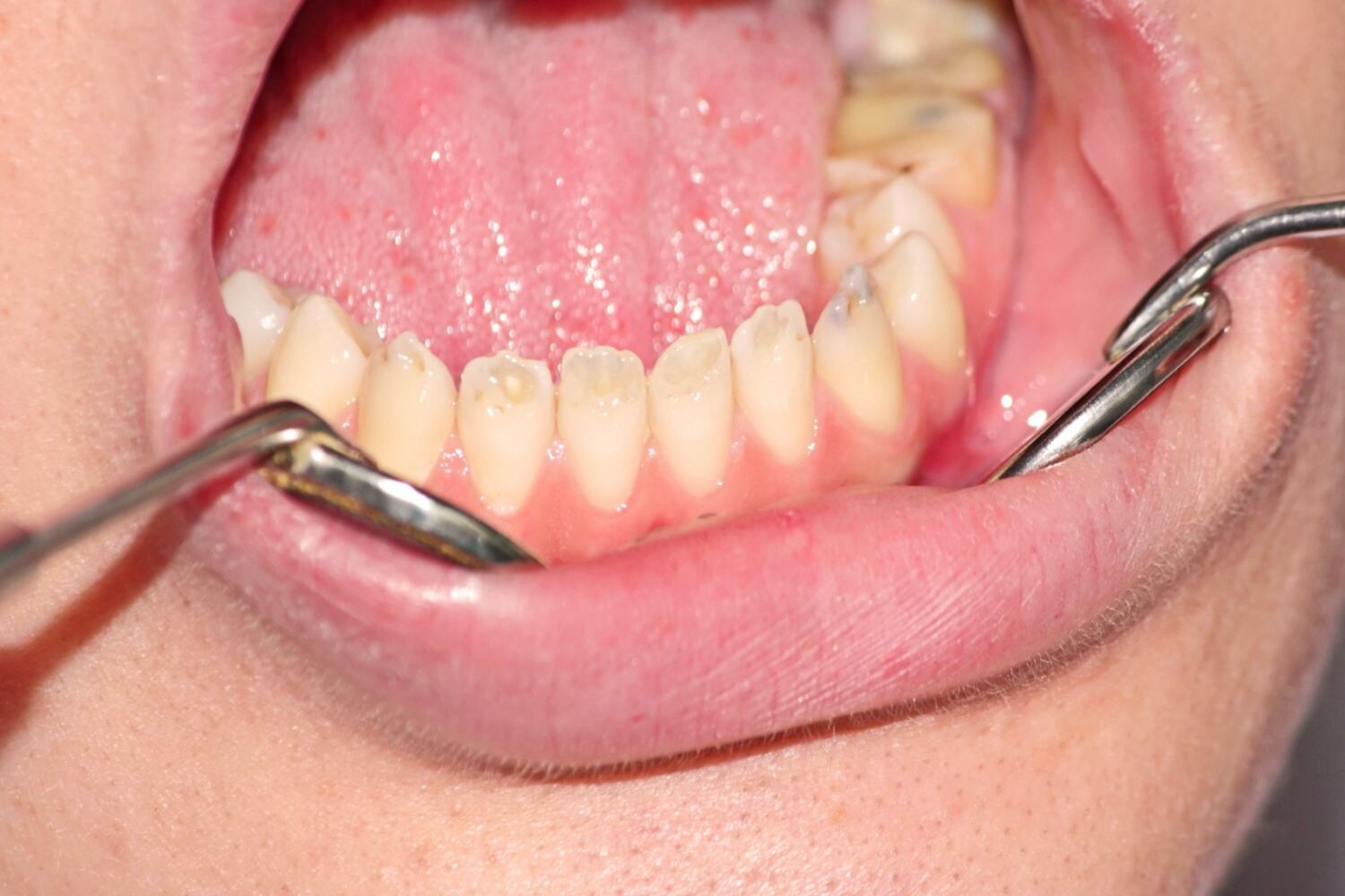 Enamel hypoplasia