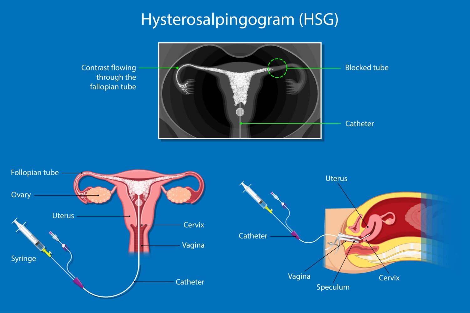 Hysterosalpinogram