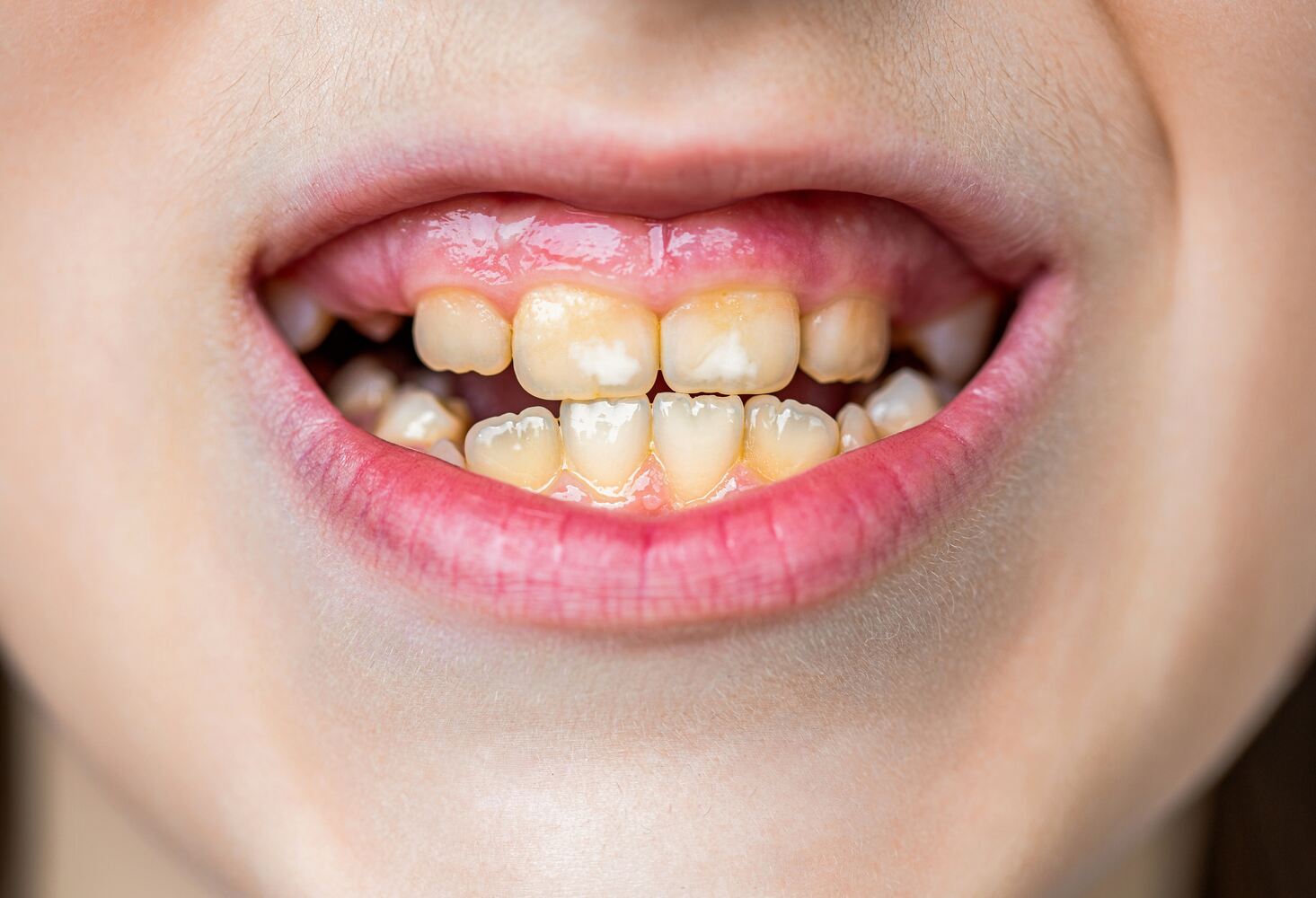 Toddler's teeth discolored