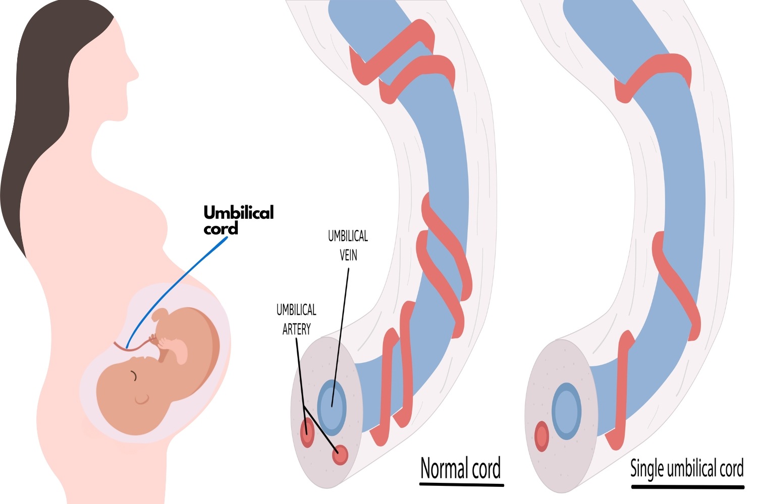 Two-Vessel Cord_ Causes, Risk Factors And Effects On Baby