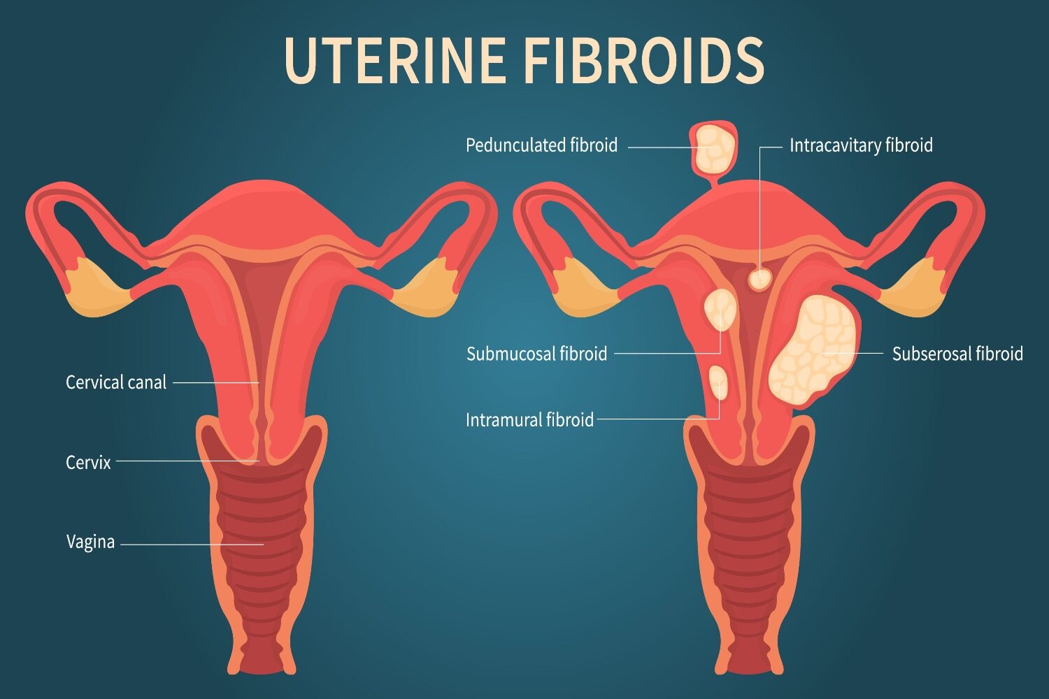 Uterine Fibroids During Pregnancy_ Symptoms And Treatment