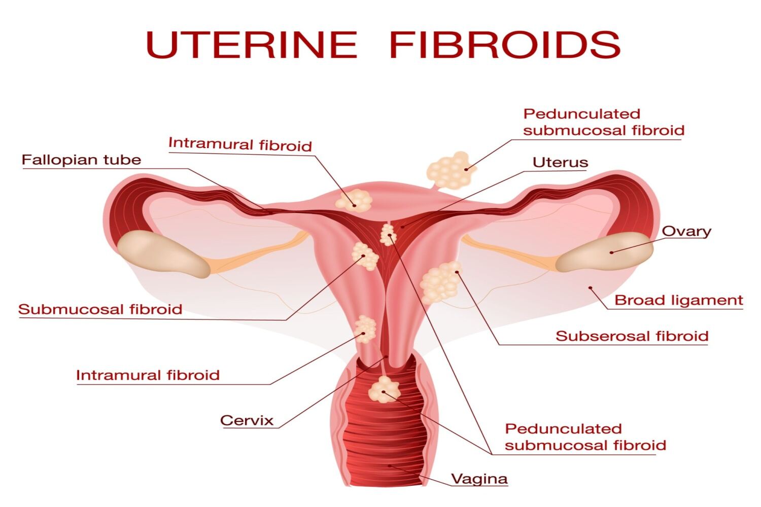 What Are The Types Of Fibroids During Pregnancy