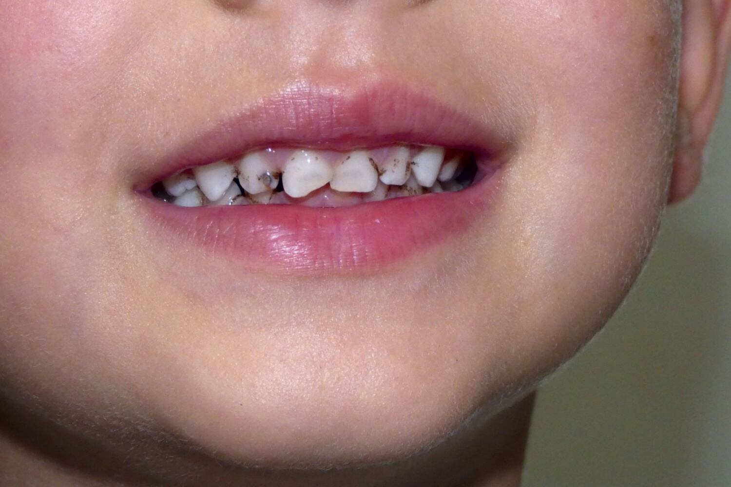 signs of baby tooth decay
