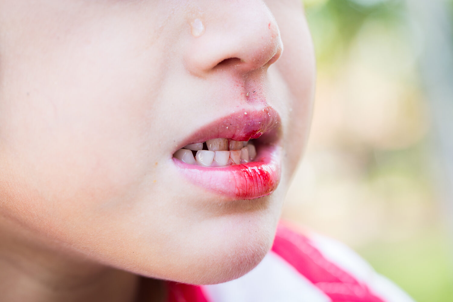 Cut or Bitten Lip, Cheek, or Tongue