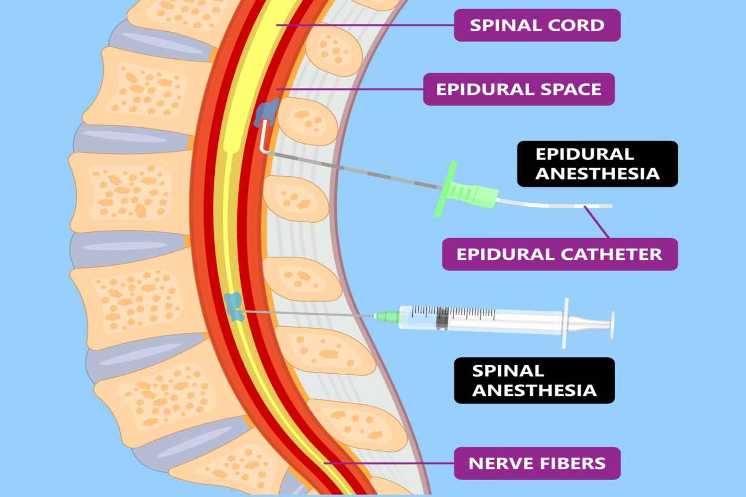 How Does an Epidural Work
