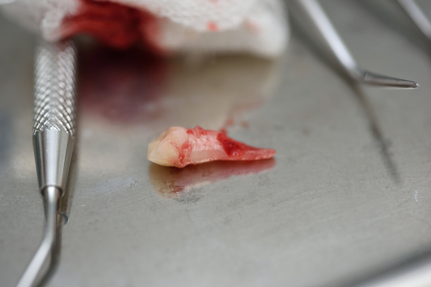 Knocked-Out Tooth or Tooth Avulsion