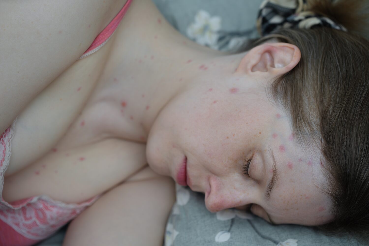 Chicken Pox During Pregnancy – Risks and Complications 