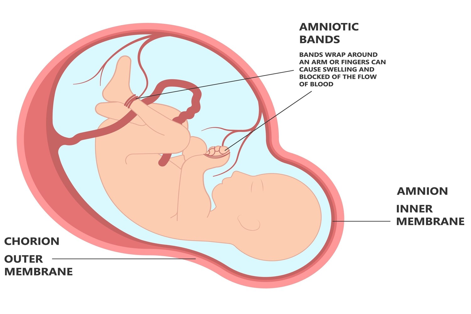 What Leads To Amniotic Band Syndrome?