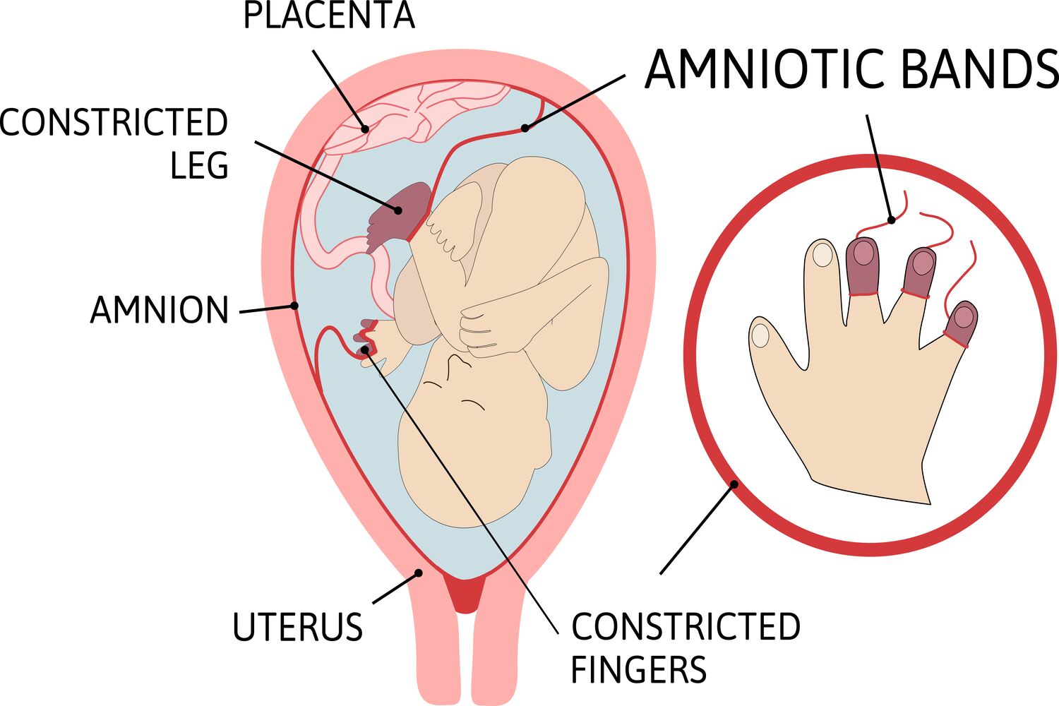 What Causes Amniotic Band Syndrome_