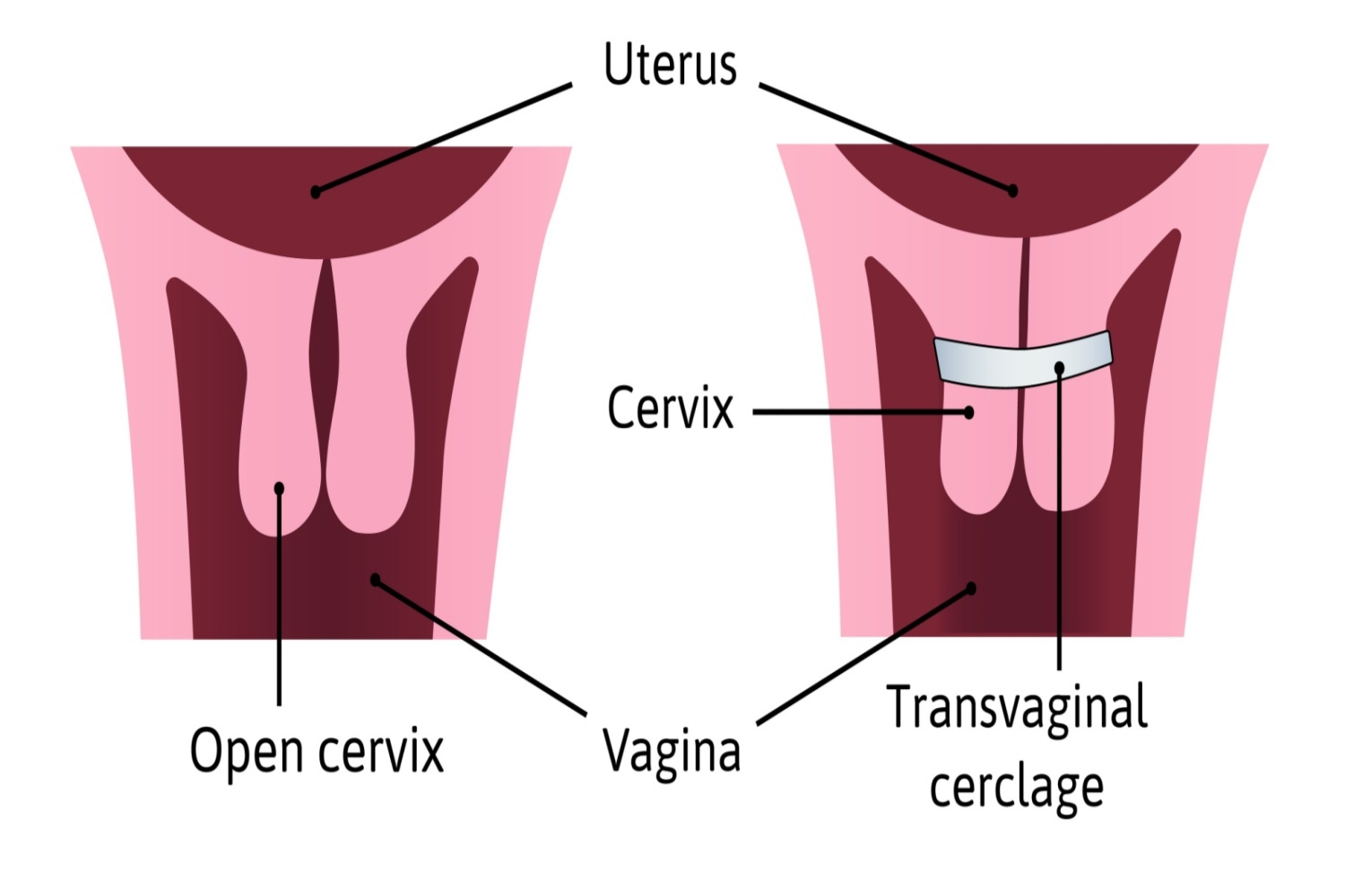 What-Is-Cervical-Cerclage_