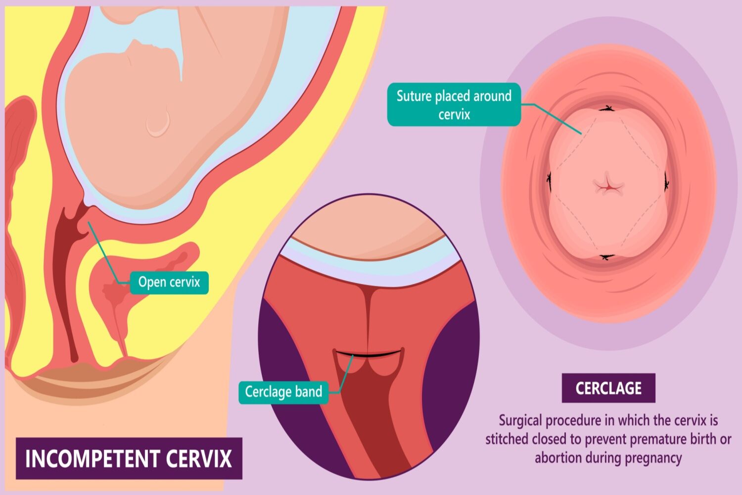 Cervical Cerclage