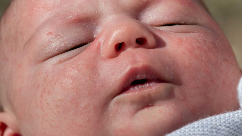 Conditions-Similar-to-Erythema-Toxicum-Neonatorum