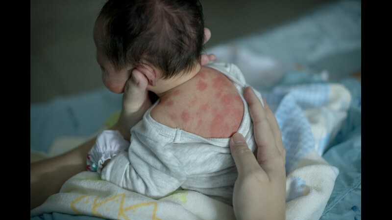 Erythema-Toxicum-Neonatorum-in-Newborns